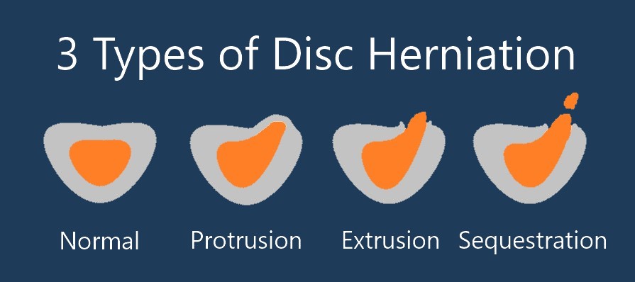 Diagram of the 3 types of disc herniation